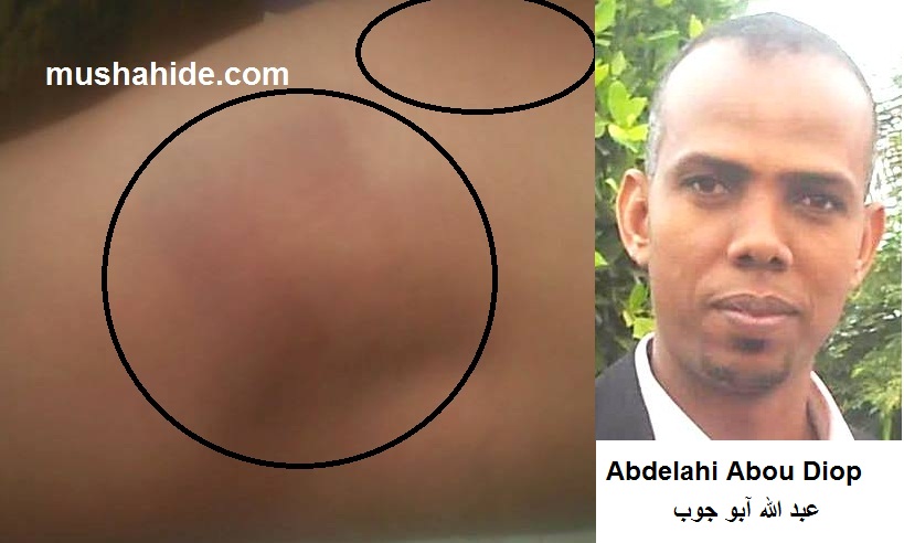 صورة اثار التعذيب على عبد الله آبو جوب في توقيف سابق مايو 2016